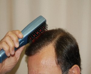 טיפול בנשירת שיער באמצעות מכשיר לייזר - מסרק לייזר 