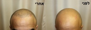 השתלת שיער לפני ואחרי