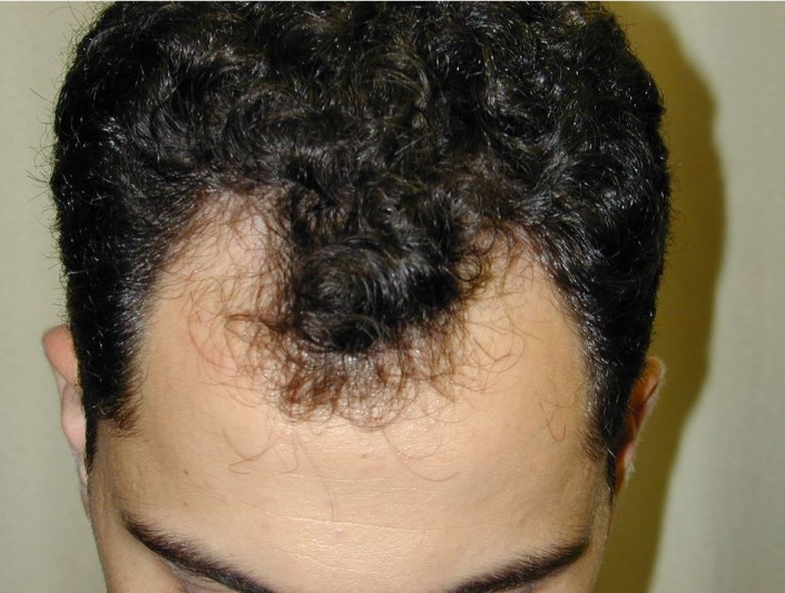 השתלת שיער לגברים - לפני השתלה במפרצים