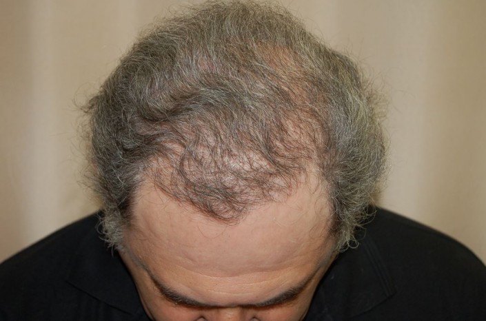 השתלת שיער לגברים - אחרי השתלה מקדימה