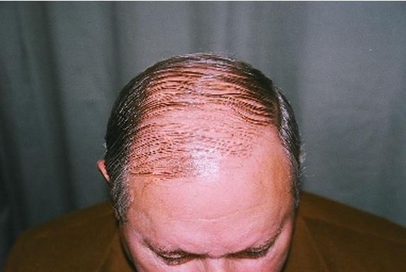 השתלת שיער לגברים - לפני השתלה מקדימה