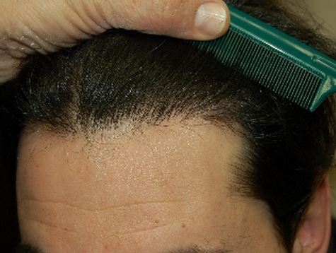 השתלת שיער לגברים - אחרי השתלה במפרצים