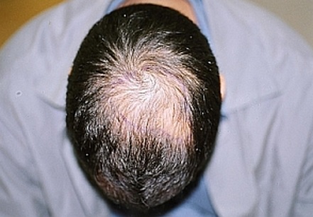 השתלת שיער לגברים - לפני השתלה בפדחת