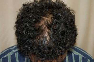 לפני השימוש במינוקסידיל נשירת שיער