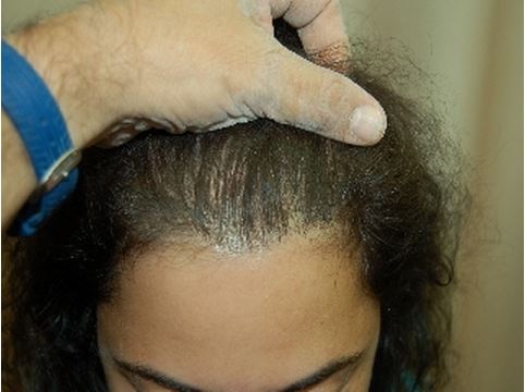 השתלת שיער לנשים - התקרחות נשית - אחרי