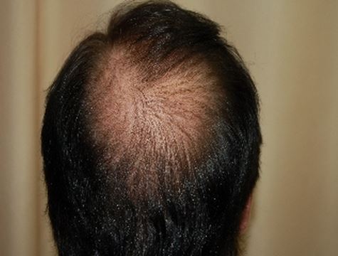 השתלת שיער לגברים - לפני השתלה מקדימה