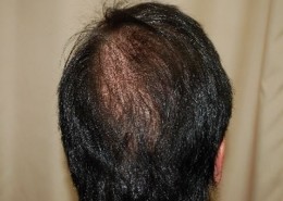השתלת שיער לגברים - אחרי השתלה מקדימה