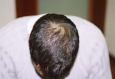 השתלת שיער לגברים - אחרי השתלה בפדחת