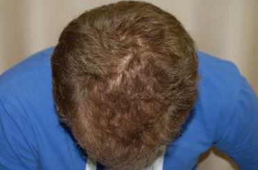 לפני השימוש בפרופסיה - נשירת שיער