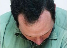 לאחר השימוש בטופיק נשירת שיער שיער דליל