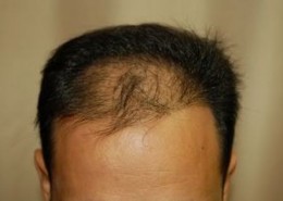 השתלת שיער לגברים - לפני